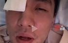 郭艾倫眼傷曝光，涉事隊友已道歉，臺灣球員或失明，專家稱風險高